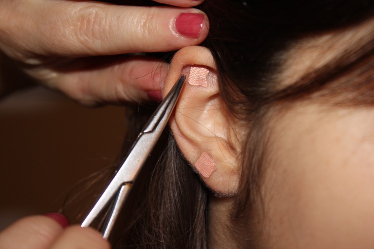 terapia de auriculoterapia para restabelecer equilíbrio